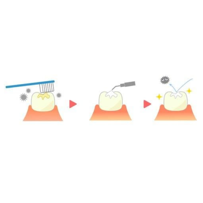 Dental Sealants